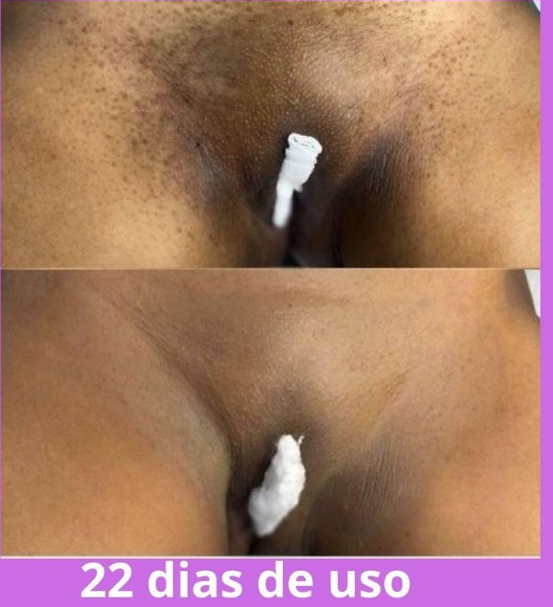 Clareamento de Virilha
